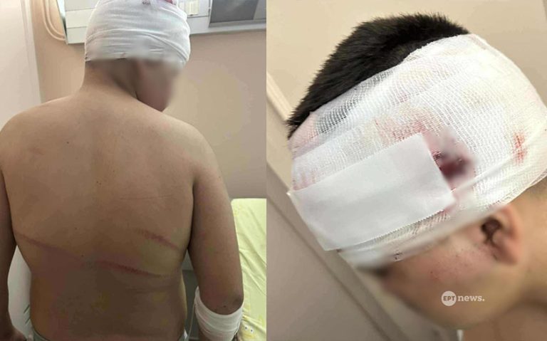 Φωτογραφίες σοκ με τα τραύματα του 13χρονου που δέχτηκε επίθεση στη Θεσσαλονίκη (photo)