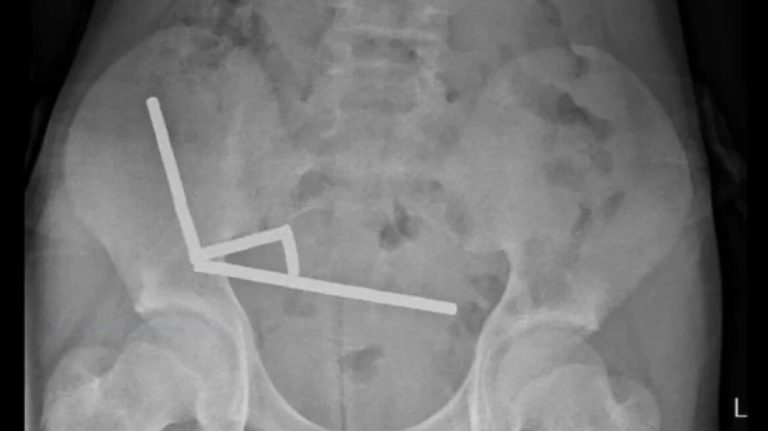 Νέα Ζηλανδία: Γιατροί έβγαλαν μαγνήτες από τα έντερα 13χρονου