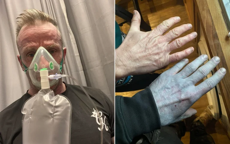 Ο Βρετανός που ξύπνησε… Στρουμφάκι: Πήγε στα επείγοντα και έγινε το ανέκδοτο της βάρδιας (Photos)